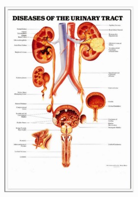 3D ANATOMICAL CHART DISEASES OF THE URINARY TRACT