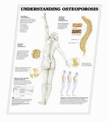 3D ANATOMICAL CHART UNDERSTANDING OSTEOPOROSIS